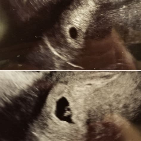 No heart beat on US Seeing a sac with fetal pole at 6 weeks is normal and I would have expected cardiac activity. . Fetal pole but no heartbeat at 6 weeks